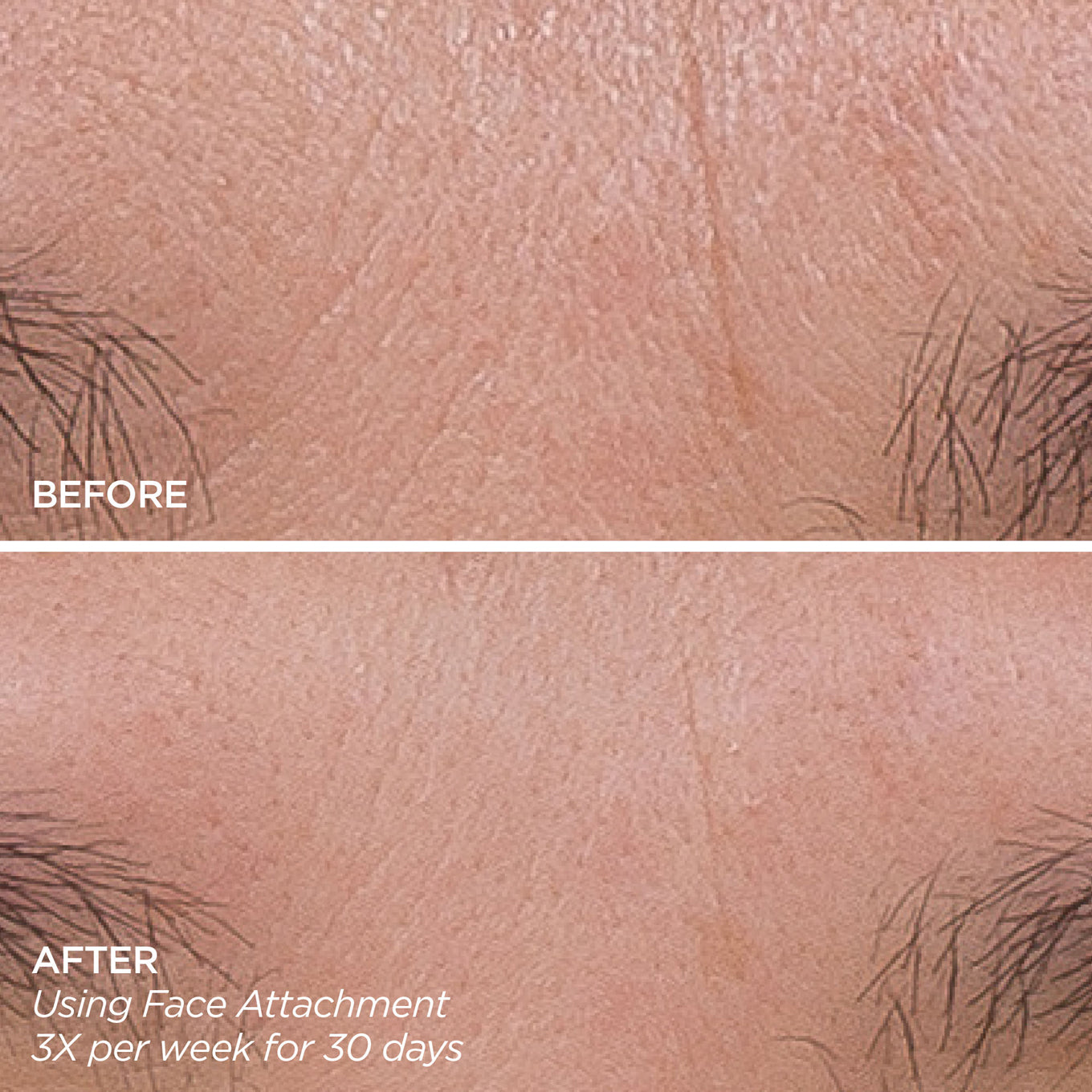GloPRO® Facial Microneedling Tool