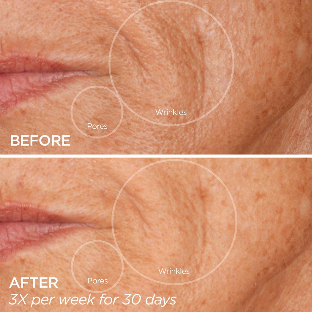 GloPRO® Facial Microneedling Tool