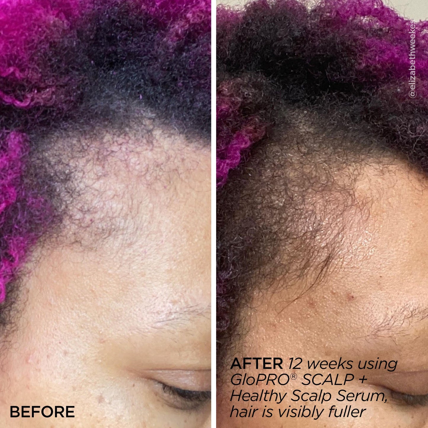 GloPRO® SCALP Attachment Head (Tool Not Included)