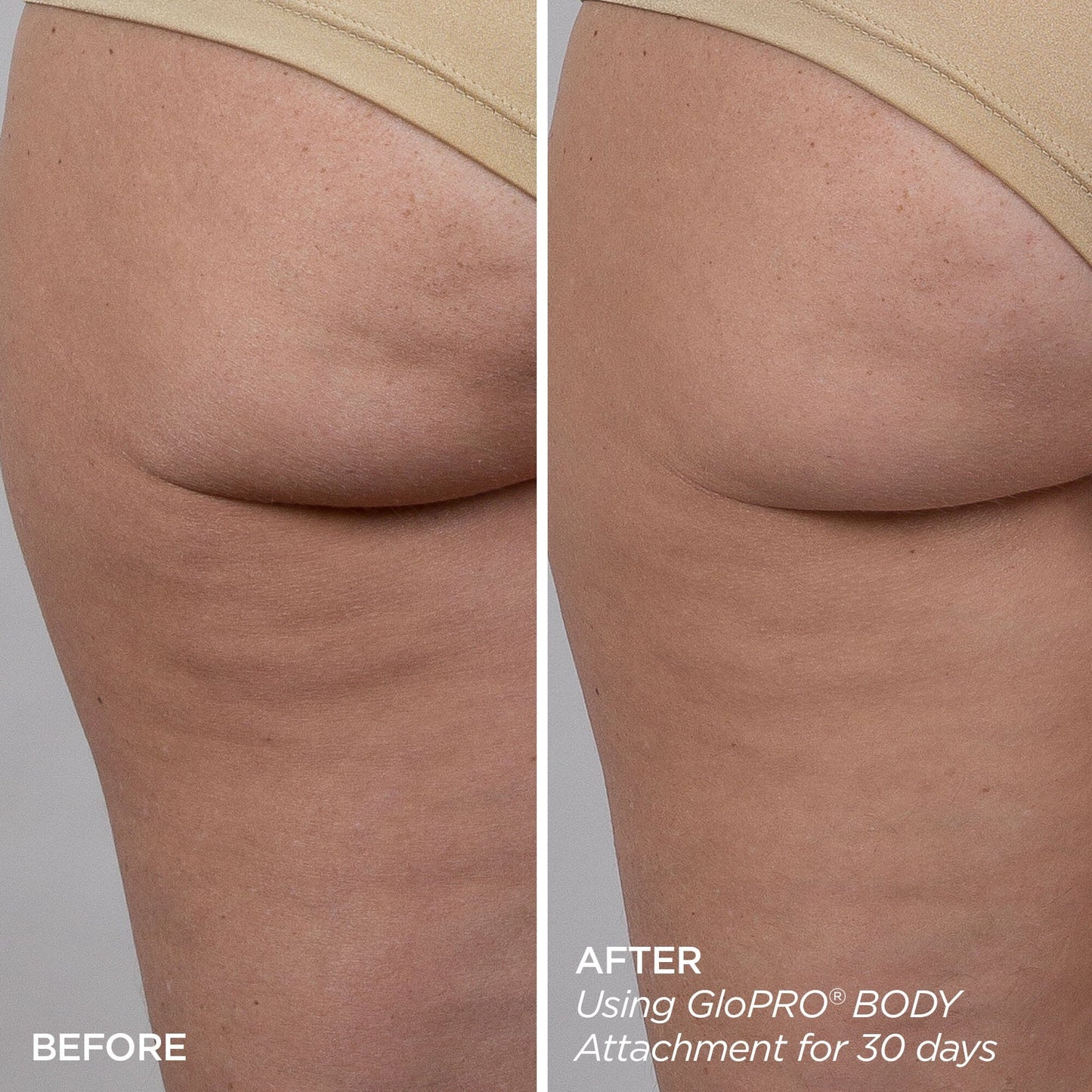 GloPRO® BODY MicroTip™ Attachment Head (Tool not included)