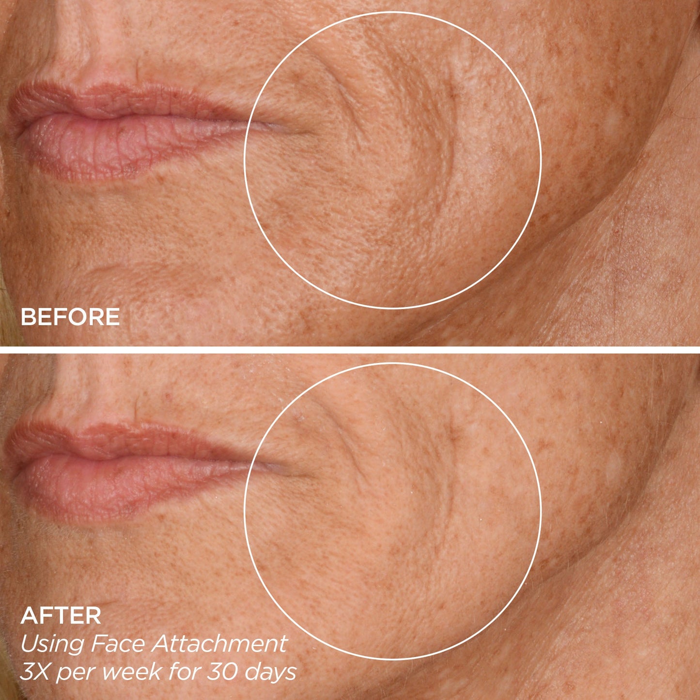 GloPRO® FACE MicroTip™ Attachment Head (Tool not included)