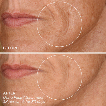 GloPRO® FACE MicroTip™ Attachment Head (Tool not included)