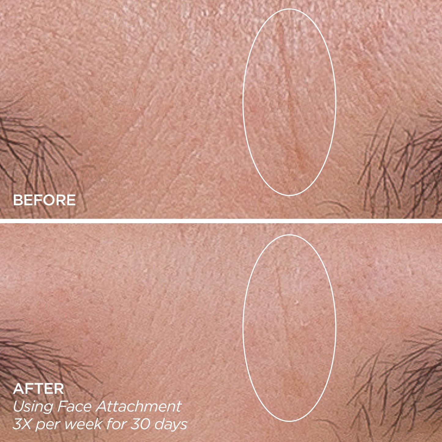 GloPRO® FACE MicroTip™ Attachment Head (Tool not included)