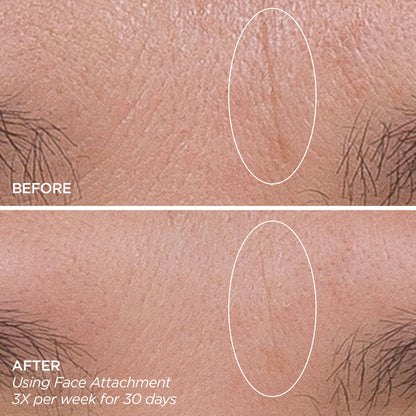 GloPRO® FACE MicroTip™ Attachment Head (Tool not included)
