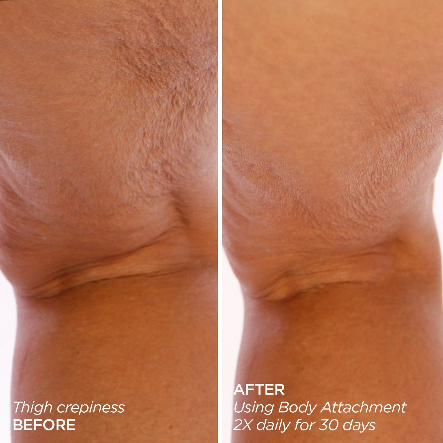 GloPRO® BODY MicroTip™ Attachment Head (Tool not included)