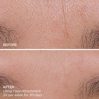 GloPRO® Facial Microneedling Tool