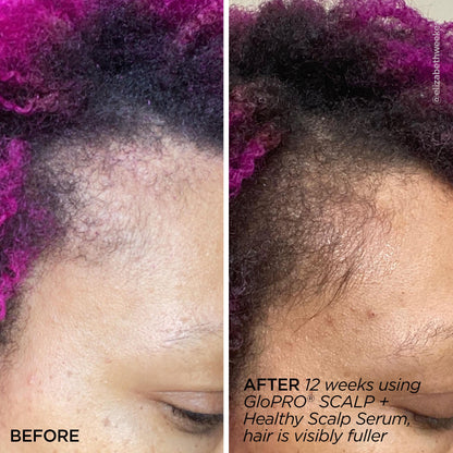 GloPRO® SCALP Attachment Head (Tool Not Included)