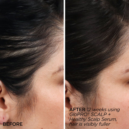 GloPRO® SCALP Attachment Head (Tool Not Included)