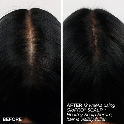 GloPRO® SCALP Attachment Head (Tool Not Included)